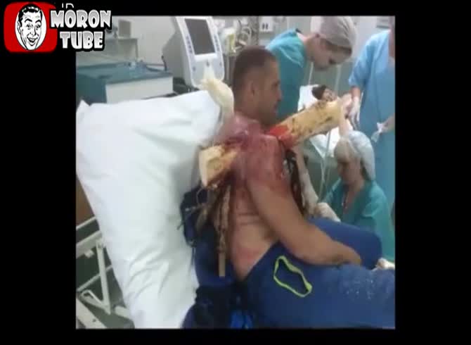 Video :A log becomes lodged in a man's shoulder (Public Averti)